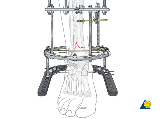 Case-Study-MP-Brace